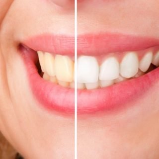 https://dayspringoakville.ca/wp-content/uploads/2021/08/TeethWhitening_slide3-768-320x320.jpg